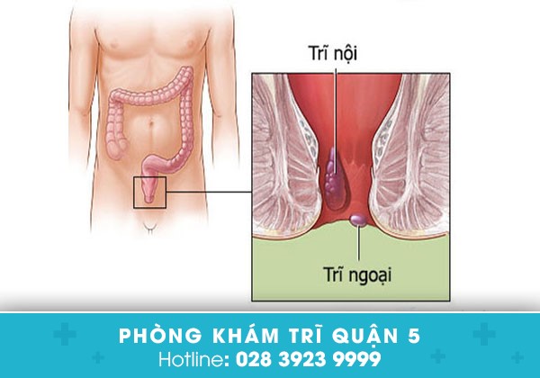 Lòi dom là bệnh gì?