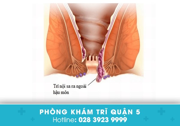 sa búi trĩ ở bệnh nhân