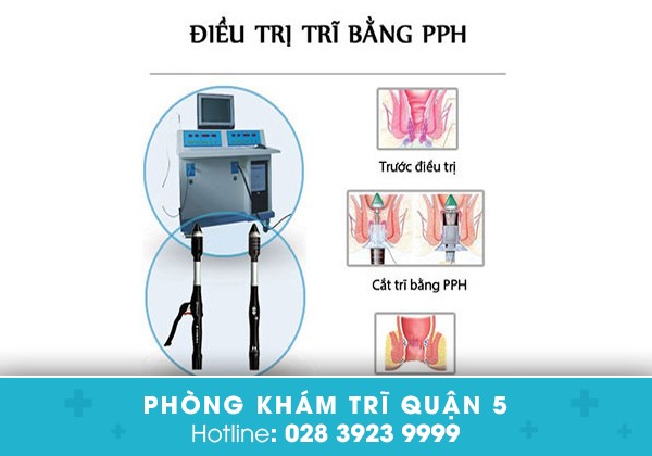 Kỹ thuật điều trị bệnh trĩ PPH 