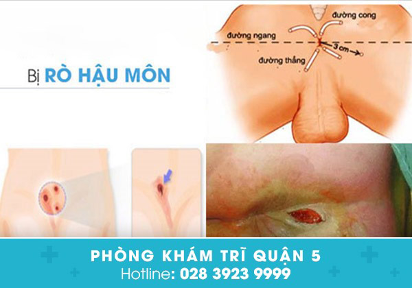 Triệu chứng nhận biết bệnh rò hậu môn